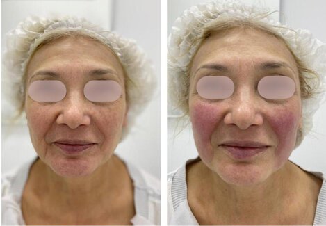 Radiant-and-youthful-skin-achieved-through-M-Azur-treatments