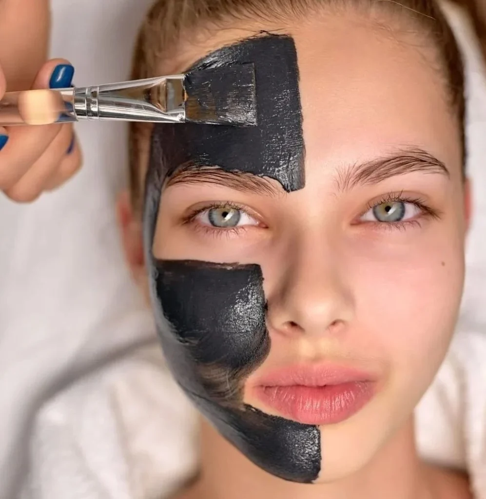 Before-and-after-results-of-M-Azur-advanced-skin-rejuvenation
